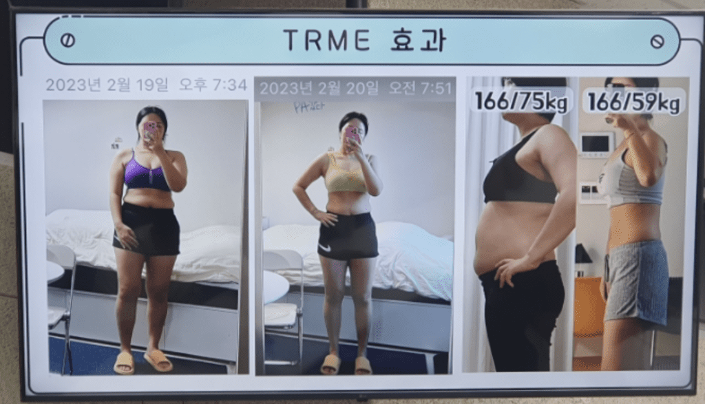 티알미TRME 다이어트의 빠르고 강력한 효과 비포 애프터 사진